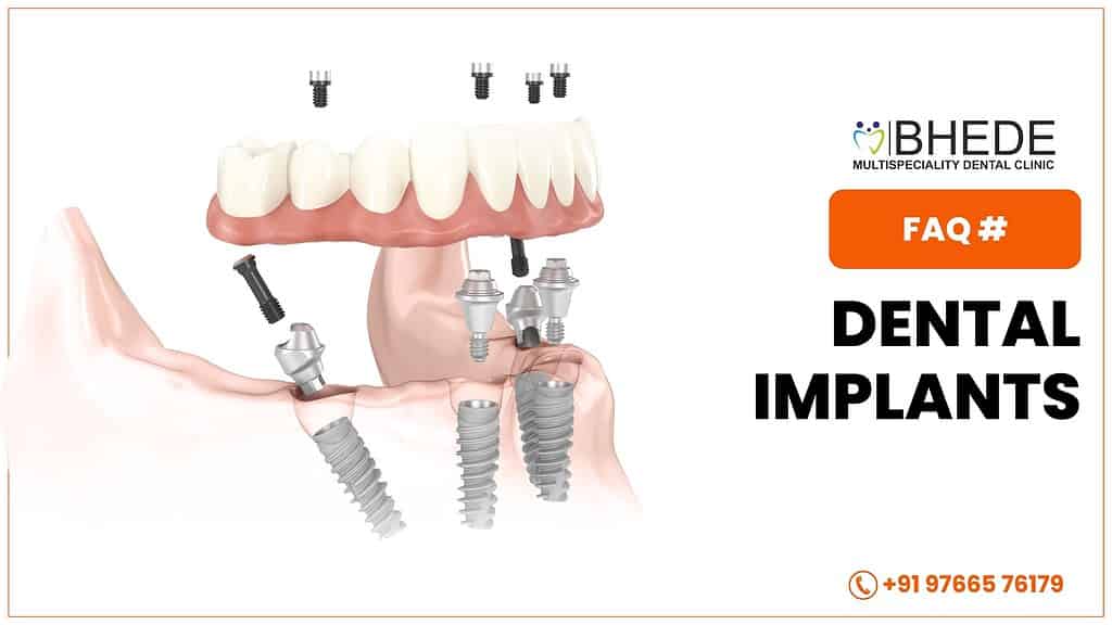 FAQ on Dental Implant by Dr. Rohan Bhede