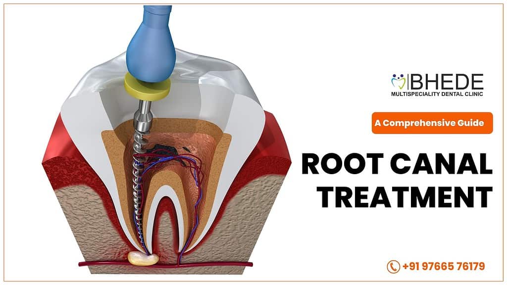 Root Canal Treatment inj Nagpur